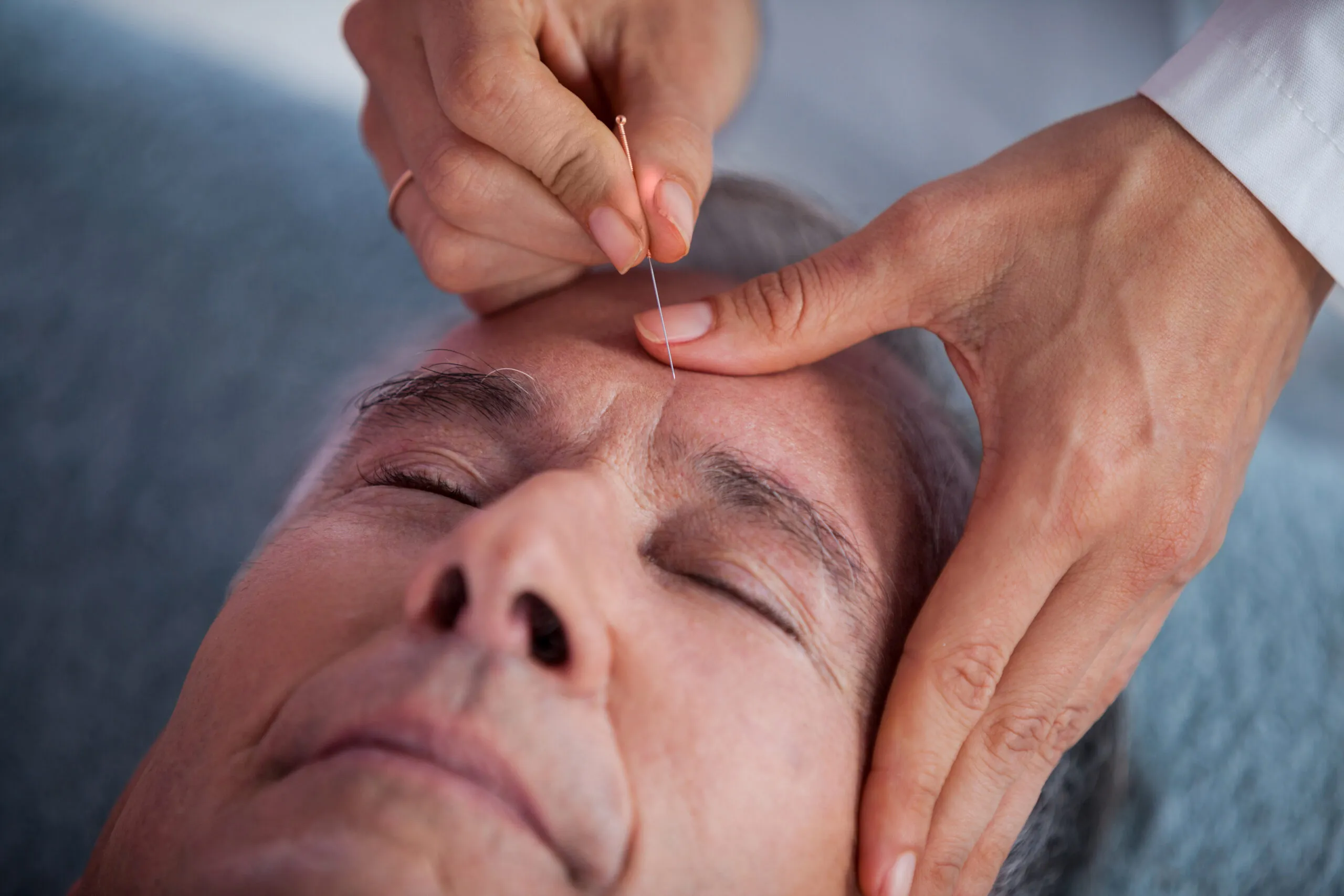 Man getting acupuncture treatment